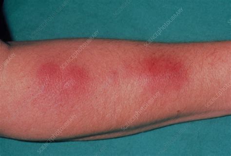 Boils On Forearm Due To Staphylococcus Infection Stock Image M120