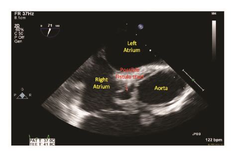 Axial Image Of The Aortic Root Abscess Demonstrating A Possible Fistula