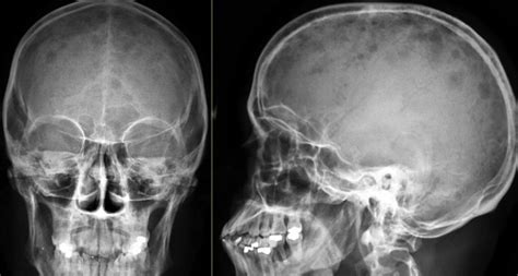 Multiple myeloma is neoplastic proliferation of plasma cells that commonly results in multiple skeletal lesions, hypercalcemia, renal insufficiency, and anemia. Multiple Myeloma Skull X Ray - Cancer OZ