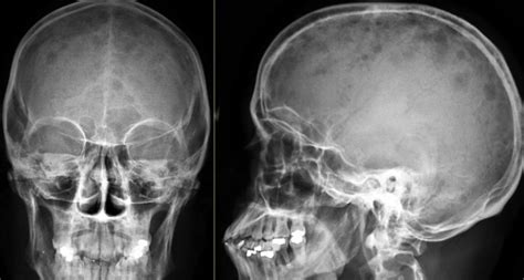Punched out multiple myeloma lytic lesions in the skull 8 multiple myeloma (mm) is a neoplastic proliferation of a clonal population of plasma cells, which produces monoclonal protein (immunoglobulin g igg, iga, and light chain protein κ or λ are the most common).1 Multiple Myeloma Skull X Ray - Cancer OZ