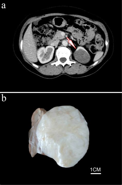 Case 1 Ct Scan Showed A Sharply Defined Mass Involving The Upper Pole