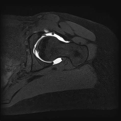 Labral Tear In The Hip Joint Radiology Case