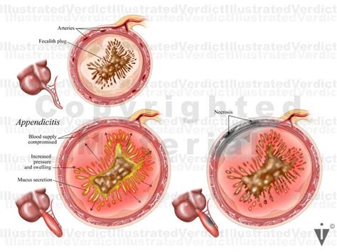 Stock Appendix Appendicitis Retrocecal — Illustrated Verdict