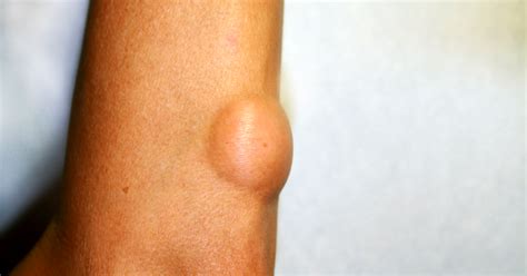 Swollen Lymph Nodes In The Armpitfree Online Doctor Chat 247