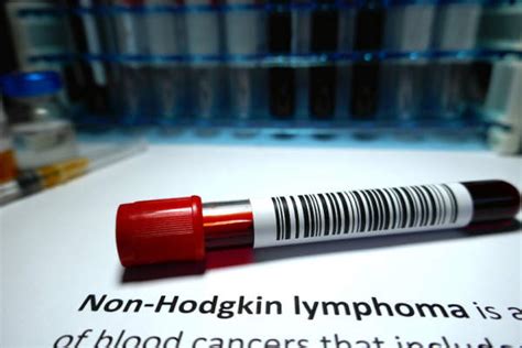 Could I Have Non Hodgkins Lymphoma A Guide To Symptoms Healthcentral