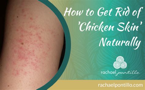 How To Get Rid Of Chicken Skin Aka Keratosis Pilaris Dorothee Padraig