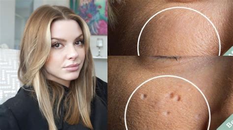 How To Get Rid Of Pitted Acne Scars