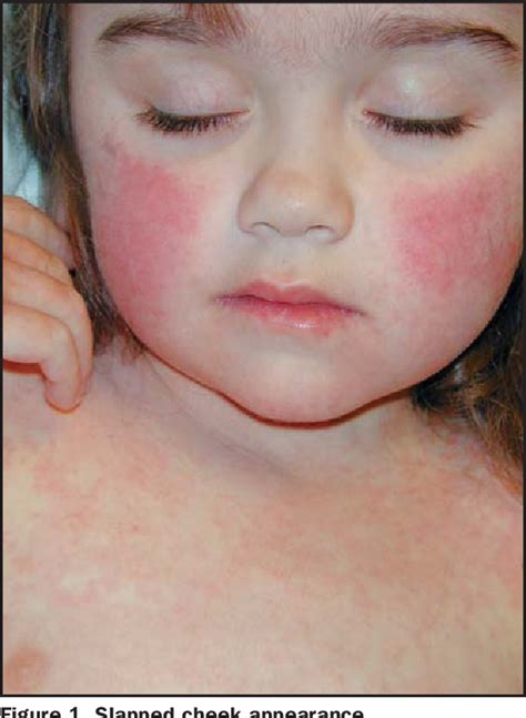 Figure 1 From Slapped Cheek Disease How It Affects Children And