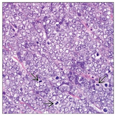 In the present immunohistochemical study, applying the cytokeratins 8, 18 and 20 as the most established markers for merkel cells (mcs), we did not find elevated numbers of mcs. Primary Neuroendocrine (Merkel Cell) Carcinoma ...