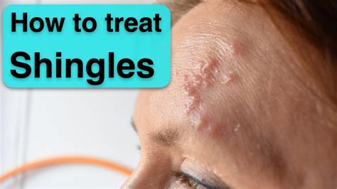 Herpes Zoster Shingles Treatment And Prevention Youtube