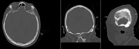 Radiology Mri Horizontal Parietal Fracture