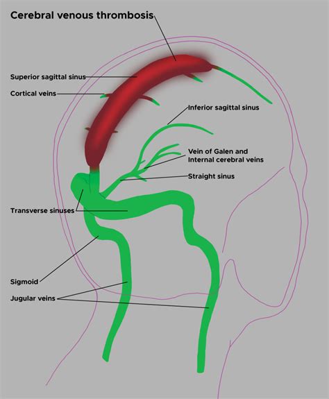 Figure Illustration Of Cerebral Venous Thrombosis Statpearls