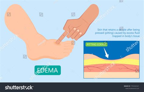 Edema Swelling Under Skin That Affect Vetor Stock Livre De Direitos