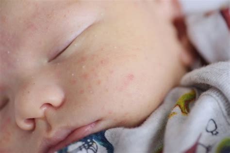 Acné Neonatal Granitos En La Cara Del Bebé Causas Y Tratamiento