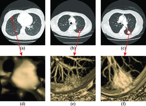 Three Types Of Lung Nodules A Isolated Nodule B 3d Image Of