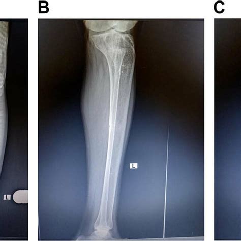 A Pa X Ray Of Tibia Cystic Lesion Of Distal Metaphysis Of Femur And