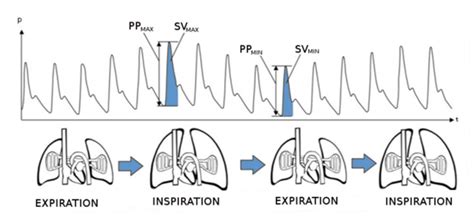 Schlagvolumenvariation Svv Und Pulsdruckvariation Ppv Flonchi