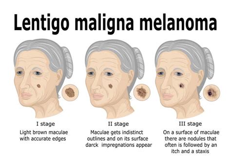 Lentigo Maligna And Lentigo Maligna Melanoma Causes Symptoms And