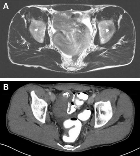 A And B Mri With Contrast Of The Abdomen And Pelvis Demonstrating A