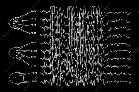 Brain Waves In Epilepsy Stock Image M150 0280 Science Photo Library