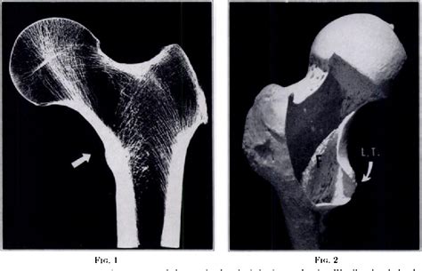 Figure 8 From The Calcar Femorale And The Femoral Neck Semantic Scholar