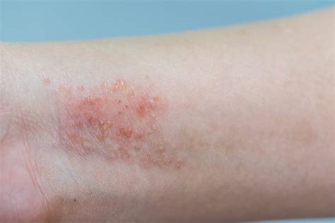 14 Doenças Que Causam Manchas Vermelhas Na Pele Com Fotos Tua Saúde