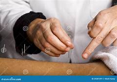 Healing Hands On Call Hire Acupuncturists And Elevate Your Practice