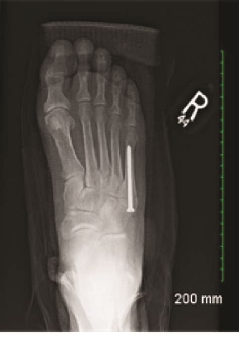 A Guide To Intramedullary Fixation Of Jones Fractures