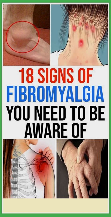 Common Signs Of Fibromyalgia You Should Be Aware Of Shape Your Body In 2020 Signs Of