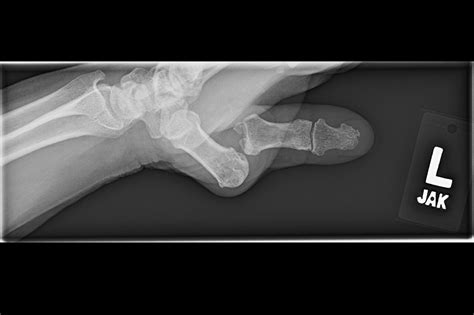 Ortho Dx Left Thumb Pain And Deformity Clinical Advisor