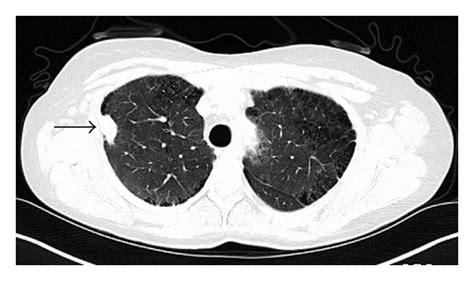 Ct Chest Showing 15 Cm × 25 Cm Rul Pleural Based Nodule Arrow