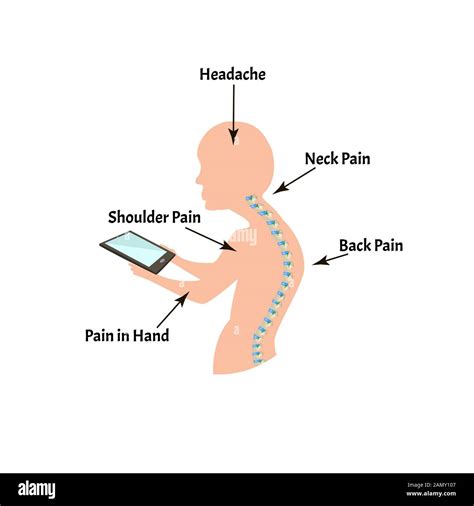 Improper Posture Symptoms Text Neck Syndrome Spinal Curvature