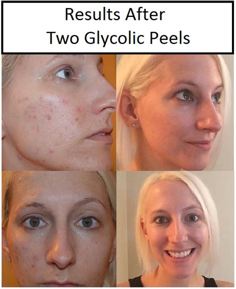 Glycolic Acid Before And After Photos