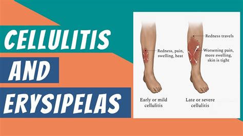 What Are Cellulitis And Erysipelas Its Clinical Features