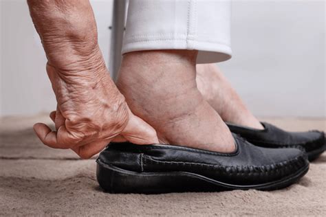 How Seniors Can Get Rid Of Swollen Ankles Aging Gracefully