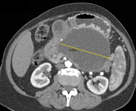 Pancreatic Pseudocyst Occludes The Splenic Vein With Extensive