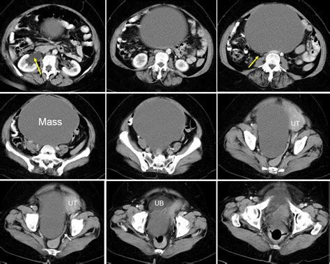 Borderline Ovarian Serous Tumour Radiology Cases