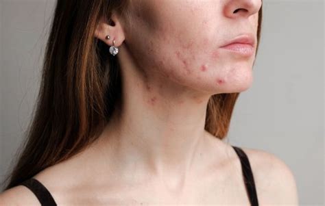 How To Get Rid Of Fungal Acne