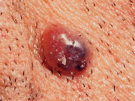 Is It Skin Cancer 38 Photos That Could Save Your Life Pictures Cbs