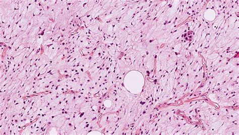 Pathology Outlines Myxoid Pleomorphic Liposarcoma