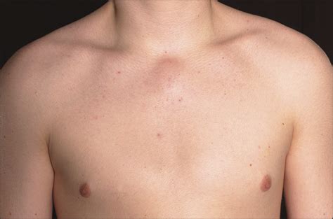 Cystic Swelling Overlying The Upper Sternum In A Teenager—quiz Case