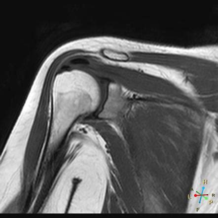 Calcific Tendinitis Radiology Reference Article Radiopaedia Org