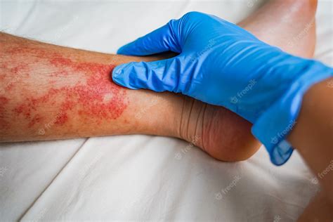 의사들은 피부병 붉은 자극 발진과 다리 습진 알레르기 벌레 물린 가려움증이 있는 환자를 검사하는 장갑을 끼고 있습니다 프리미엄 사진