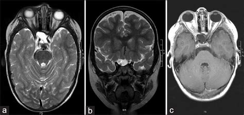 Extranodal Right Optic Nerve Rosaidorfman Disease A Rare Localization