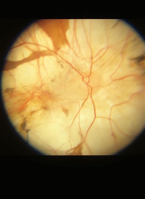 Congenital Monocular Choroidal Atrophy Retina Image Bank