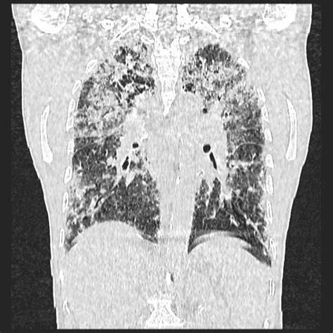 Pin On Interstitial Lung Diseases