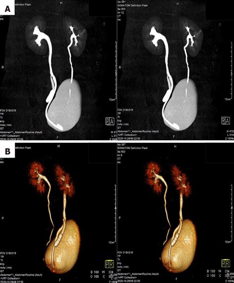 Inverted Y Ureteral Duplication With An Ectopic Ureter And Multiple