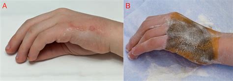 Two Patients With Localised Hyperhidrosis Of The Hand Based On