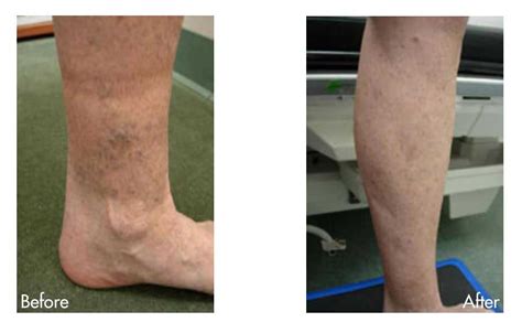 Before And After Photos By Our Houston Vein Doctor Texas Vein
