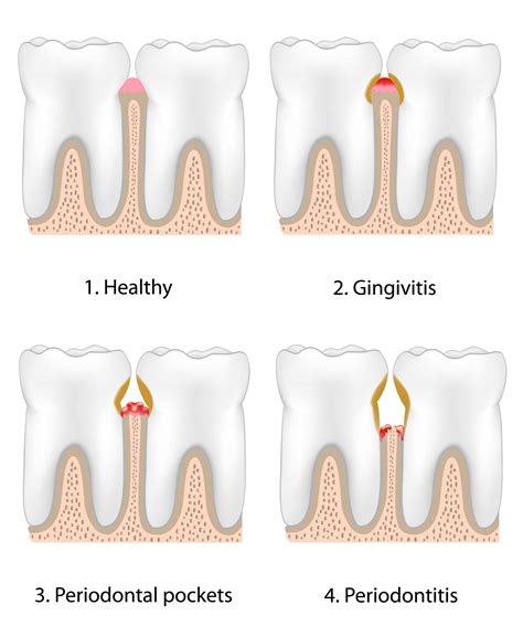 Causes Of Infection In Gums at William Conover blog